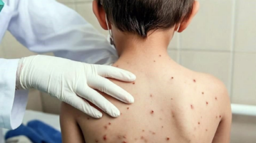 Measles reaches Lakeside as Jalisco cases top four hundred